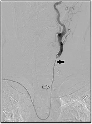 Use of reverse angle guide catheter with trans-radial approach in patients undergoing middle meningeal artery embolization